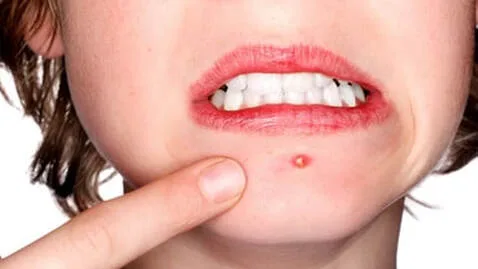 Does popping a zit make it worse or better and how to pop a zit without causing acne scars or infection or making it worse cystic acne tips for oily skin 