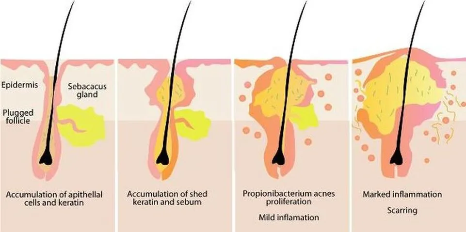 How to prevent clogged pores and hair follicles what causes acne breakouts and how to kill acne bacteria and heal a zit fast 